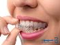 امکانسنجی و طرح توجیهی طرح تولید پلاک شفاف دندانی (نامرئی)